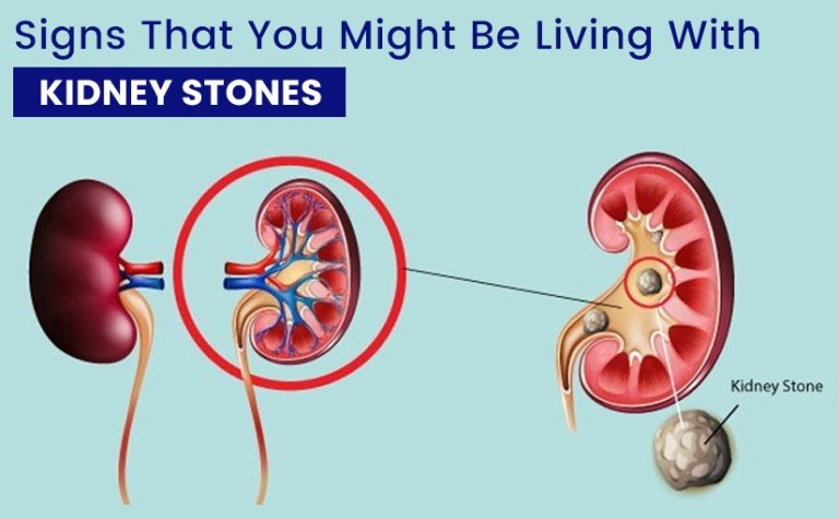 Signs That You Might Be Living With Kidney Stones