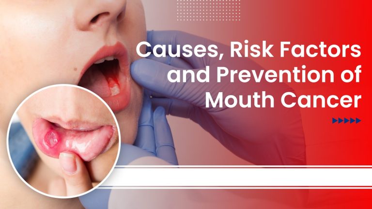 Causes, Risk Factors, and Prevention of Mouth Cancer.